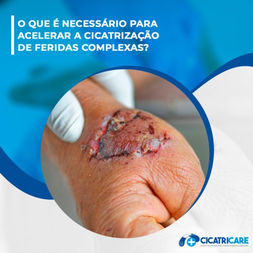 O que é necessário para acelerar a cicatrização de feridas complexas?