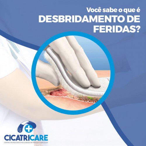 Você sabe o que é desbridamento de feridas?