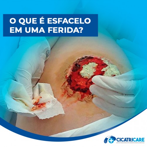 O que é esfacelo em uma ferida?