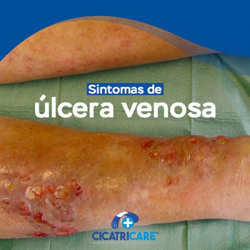 Sintomas de úlcera venosa